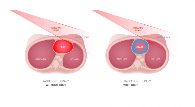 Deep Inspiratory Breath Hold (DIBH) is a game changing modern technique in Breast Cancer Radiotherapy